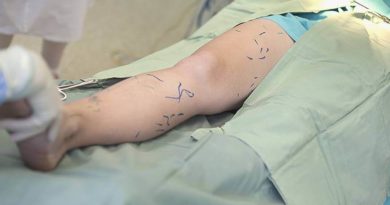 Microcirurgia de Varizes tratamento de varizes