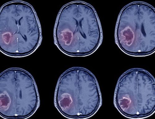 O que é tumor cerebral?